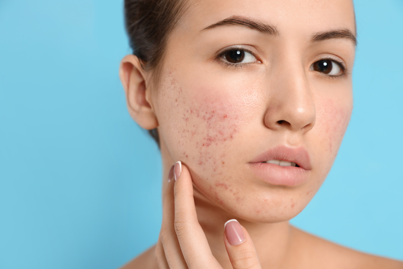 Teen Girl with Acne Problem on Light Blue Background